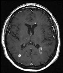 Mri has made it possible to visualize and understand much more about the underlying pathology of the disease. Mr Imaging Of Multiple Sclerosis Radiology