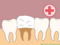 The heat from the coffee can cause pain in your nerve endings. 4 Ways To Prevent Dry Socket After A Tooth Extraction Wikihow