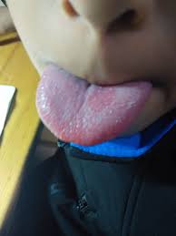 舌头上的红斑- 口腔医学专业讨论版- 爱爱医医学论坛-