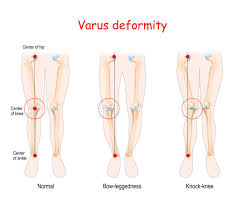 Image result for Genu Varum