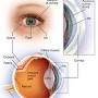 Laser eye surgery from www.mayoclinic.org