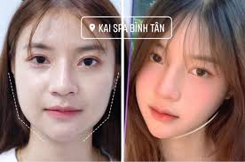 🔥🔥🔥 𝐓𝐈𝐄̂𝐌 𝐁𝐎𝐓𝐎𝐗 𝐓𝐇𝐎𝐍 𝐆𝐎̣𝐍 𝐇𝐀̀𝐌 #Botox Vip siêu mạnh  ➡tạm biệt gương mặt góc cạnh ➡lấy lại gương mặt thon gọn vline ⛔️⛔️ 𝘊𝘰̛  𝘩𝘢̀𝘮 𝘵𝘰 𝘣𝘢̂̉𝘮 𝘴𝘪𝘯𝘩 , 𝘩𝘰𝘢̣̆𝘤 𝘱𝘩𝘢́𝘵