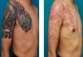 Tattoo removal has really come a long way in recent years. Laser Tattoo Removal Before And After Update 2021 Tattoo Removal Cost Tattoo Removal Laser Tattoo