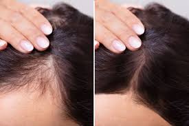 Estas Vitamina Ayudan A Evitar La Caida Del Cabello