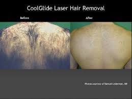 It can effectively solve various skin problems. After Your Laser Hair Removal Treatments