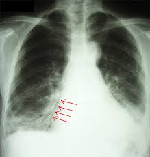 Image result for Air Bronchogram