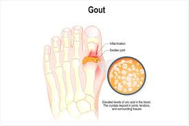 Pictures of gout in big toe. Gout An Overview
