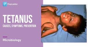Image result for Tetanus