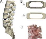 Frontiers | The effects of cage on endplate collapse after ...