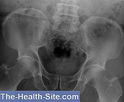 Maybe you would like to learn more about one of these? Scleroza La È™old Decat SÄƒ Tratezi InflamaÈ›ia È›esutului Conjunctiv Al Genunchiului