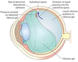 Risks associated with vitrectomy include, but are not limited to, cataract formation, retinal tear and detachment, macular pucker, and macular edema (swelling). Retinal Tear