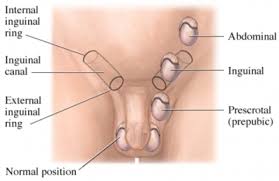 Image result for Undescended Testicle