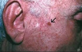 This picture gallery contains some examples of the more common. Treasure Coast Dermatology Dermatologists Of Florida Squamous Cell Carcinoma