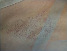 Not to mention the ingrown hairs, cysts and razor burn that come with repeatedly shaving your underarms. Laser Hair Removal Eufoton