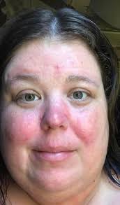 ☀️🌞 66 years old ,10 weeks after surgery! 👸💪 Tina lost 110 pounds over  the last 3 years. ⚡️💃 While she feels amazing and energized, her weight  loss accelerated her facial aging