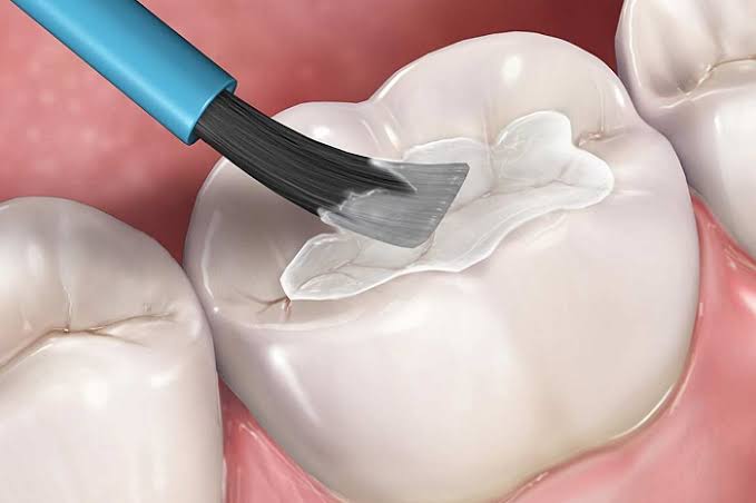 niềng răng có được dùng bảo hiểm y tế