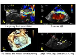 Bip39 mnemonic phrase is a list of words that store all the information needed for the recovery of a bitcoin wallet. Point Of Care Ultrasound Diagnosis Of Endocarditis Emottawa Blog