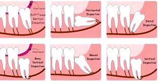 Will wisdom teeth pain go away on its own? Impacted Wisdom Tooth Extraction What Does It Mean