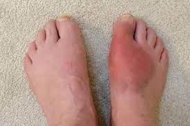 Image result for gout symptoms toe
