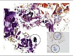 .некоторые виды дрожжей (saccharomyces cerevisiae, saccharomyces uvarum, schizosaccharomyces pombe) и бактерии (erwinia amylovora, sarcina ventriculi. Figure 3 From A Rare Case Of Sarcina Ventriculi Of The Stomach In An Asymptomatic Patient Semantic Scholar