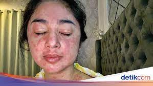 Jangan sampai hand sanitizer terkena mata, ini akibatnya. Dialami Dewi Persik Saat Kena Corona Ini Tanda Ruam Yang Jadi Gejala Covid 19