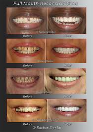 Maybe you would like to learn more about one of these? Dentist Nyc Top Prosthodontist Nyc Sachar Dental Nyc