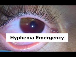 Image result for Hyphema