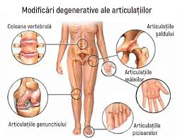 Neglijarea deformarilor de coloana poate avea implicatii grave asupra organismului. Seragem Tratament Articular Menisc Al Tratamentului Conservator Al Genunchiului