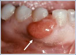 Image result for granuloma gum disease