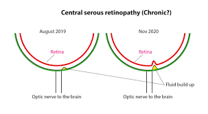 Maybe you would like to learn more about one of these? Central Serous Retinopathy Csr Cscr Cataract Forums Patient