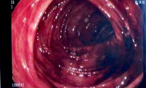 Image result for Colonoscopy in GI Bleeding