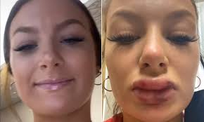 The pace and place at which the physician injects make a big impact on the likelihood of swelling. Woman Shares Shocking Video Of Her Swollen And Bruised Lips After She Got Filler Injections Daily Mail Online