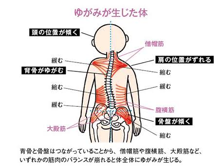 姿勢の歪みと筋肉の緊張が神経圧迫を生む（AI 生成）