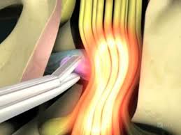 To view this video please enable javascript, and consider upgrading to a web browser that supports html5 video. Spine Surgery Youtube