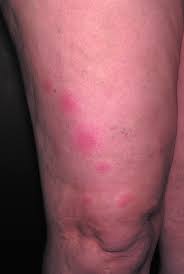 Image result for Linear Dermatitis
