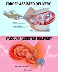 Image result for Vacuum Caput