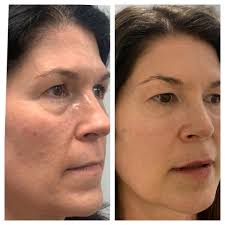 TOP 10 BEST Pdo Thread Lift in Austin, TX