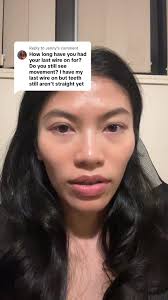 Adult Braces Journey: Concerns About Tooth Movement