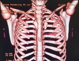 Stomach ribs lungs picture / singing from the diaphragm a. Northern Cape Teen Born Without Breastbone Makes Sa Medical History You