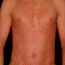 Most people are infected by the virus as children, when the disease produces few or no symptoms. Amoxicillin Rash In A Patient With Infectious Mononucleosis Patient Download Scientific Diagram