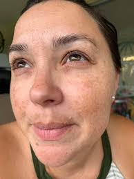 Dr. Massick, dermatologist at #OSUWexMed talks about the "melasma  mustache," and how to treat this skin discoloration.