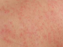 Eczema Can Get Worse In The Winter Months Reduce Protein In Diets Nuts Eggs Diary Meat Reduce Bathing Mild Soa Rash Treatment Heat Rash Treatment Heat Rash