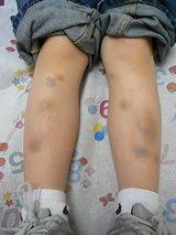 Pin On Tar Syndrome