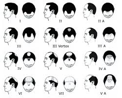 Men and women are battling with hair loss while in their 20s and 30s. Male Hair Loss Manhattan Nyc True Dorin Medical Group Hair Restoration
