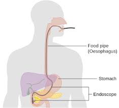 Pancreatic cancer is a cancer that's found anywhere in the pancreas. Pancreatic Cancer Cancerquest