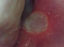 Usually lumps or bumps in the mouth can be easily treated. Red Spots On Roof Of Mouth Causes And Other Symptoms