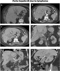 Ashish sinha and jose dolz. Validity Of Mdct Cholangiography In Differentiating Benign And Malignant Biliary Obstruction Egyptian Journal Of Radiology And Nuclear Medicine Full Text