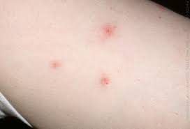 Bug Bites Pictures Slideshow Identifying Bugs And Bug Bites Bed Bug Bites Bed Bug Bites Pictures Identifying Bug Bites