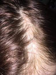 The medical term for this is hirsutism. Will My Hair Grow Back Glow Community
