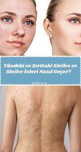 Yuzdeki Ve Sirttaki Sivilce Ve Sivilce Izleri Nasil Gecer Kiyafet Kombinleri Sivilce Izi Dogal Akne Tedavisi Cilt Bakimi